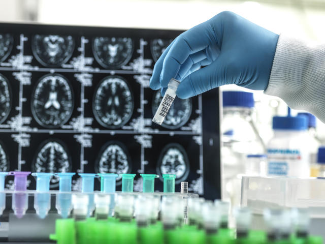 New Drug for Alzheimers Currently in Clinical Trial